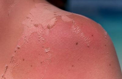 Cinci arsuri solare pot dubla riscul de melanom, potrivit medicilor