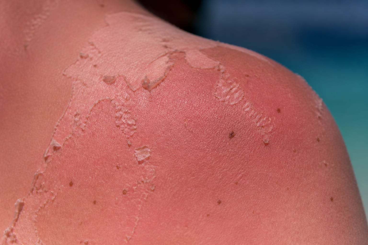 Cinci arsuri solare pot dubla riscul de melanom, potrivit medicilor